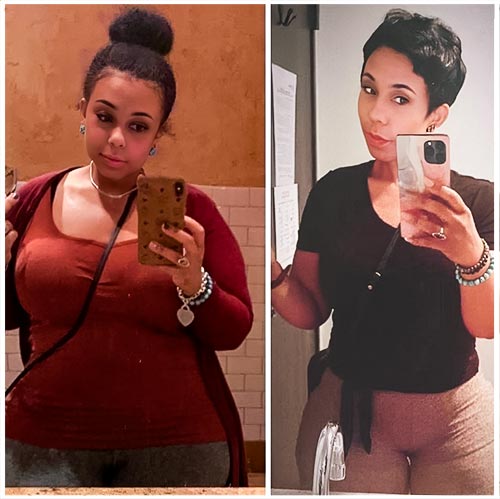 Patient weight loss transformation before and after — result 1