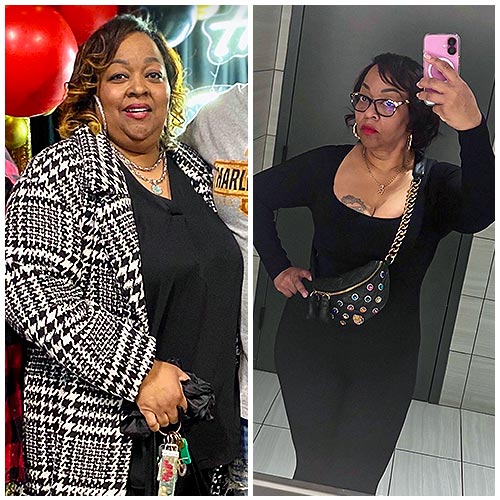 Patient weight loss transformation before and after — result 7